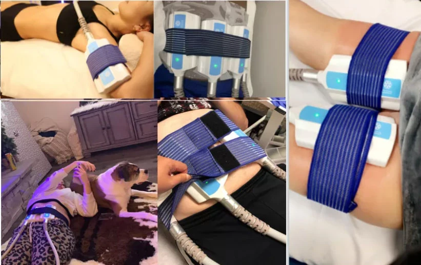cryoskin-therapy